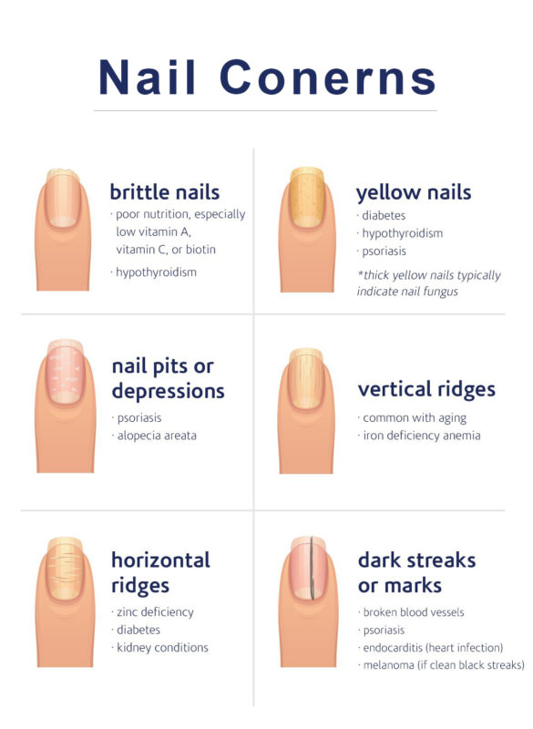 Nail Concern