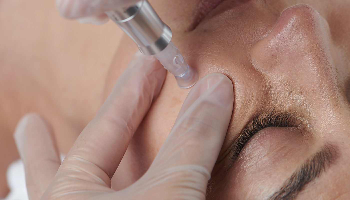 Micro needling treatment
