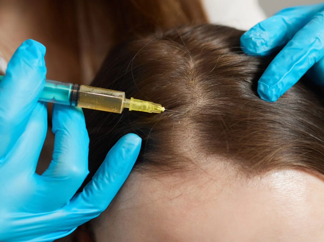 Hair Restoration PRP