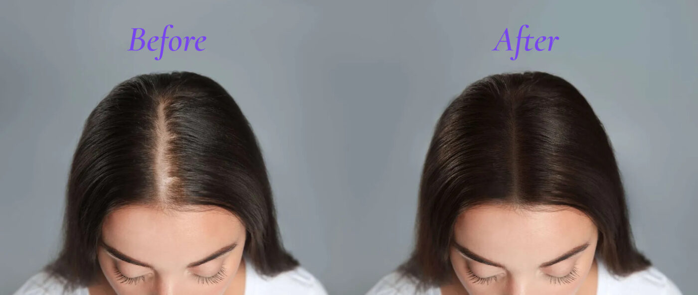 Hair Restoration