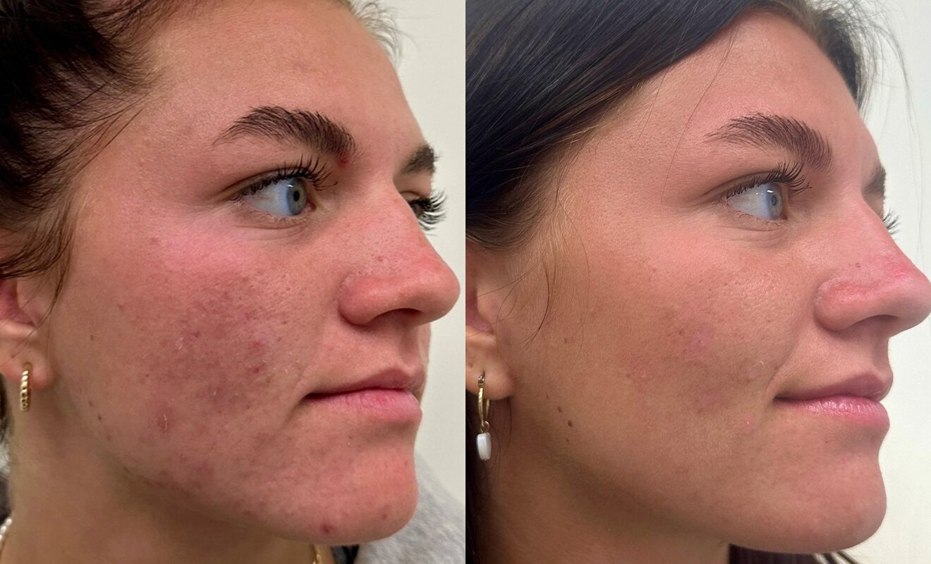 Microneedling Aftercare