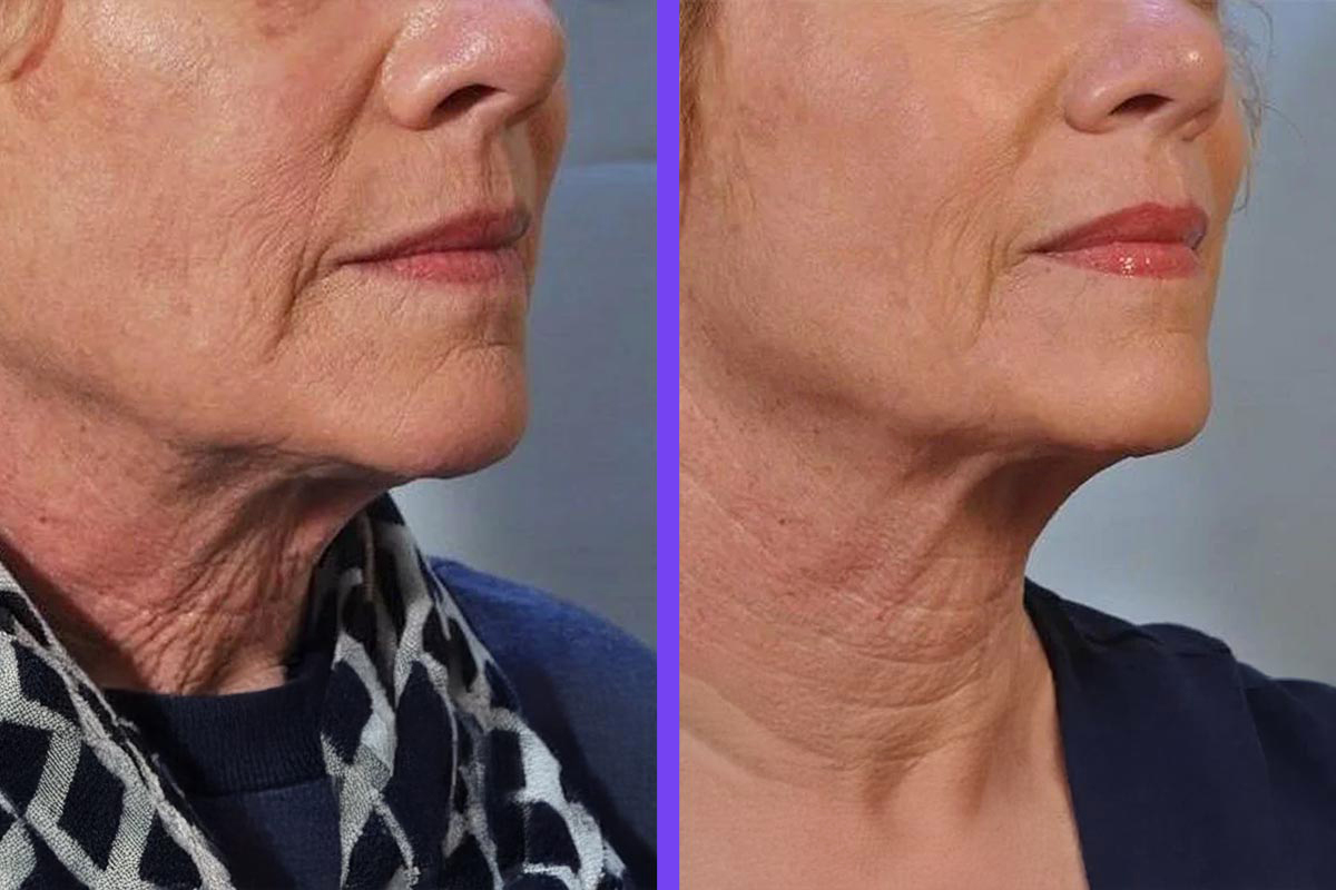 skin rejuvenation