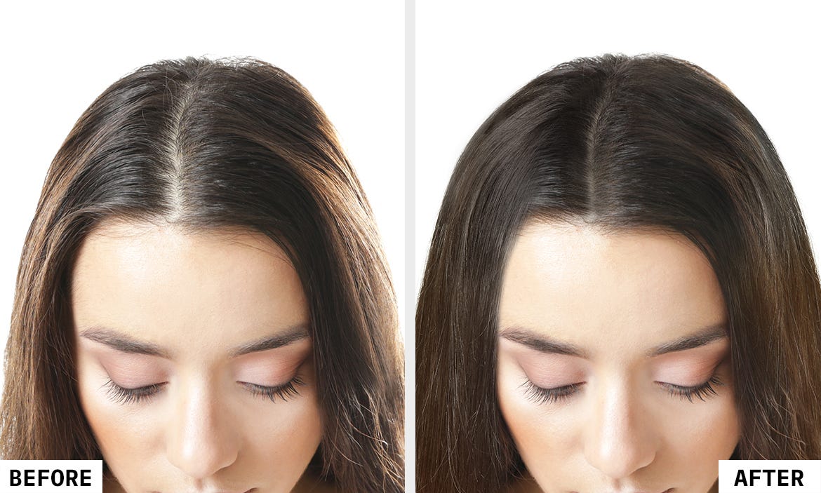Hair Restoration